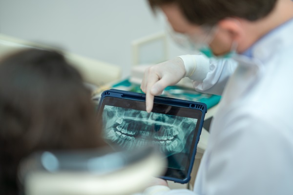 Root Canal Aftercare: Tips For A Smooth Recovery